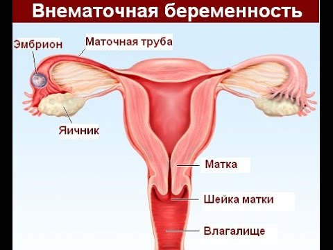 Внематочная беременность - причины, признаки, последствия, лечение
